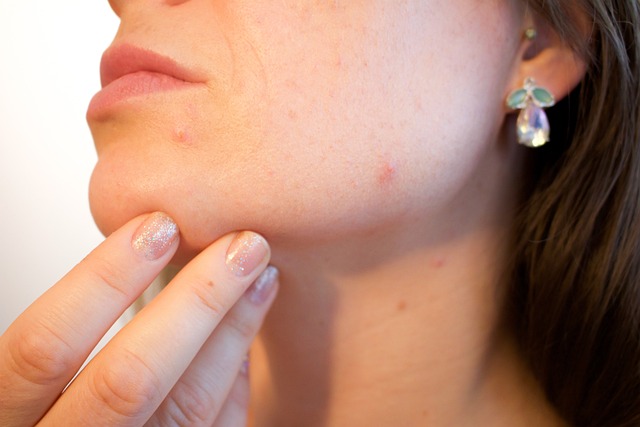 Understanding Skin Picking Disorders and How Clinical Hypnotherapy Can Help With Your Skin Care